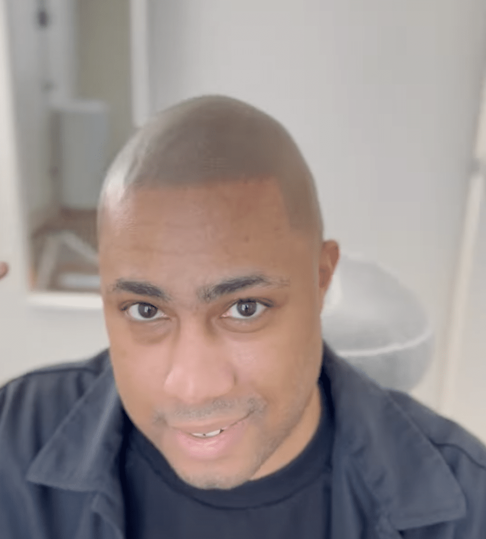 Botched scalp micropigmentation at a different shop. fixed by Edge Scalp Ink.